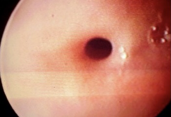 تصویر تنگی مری در اندوسکوپی در بیمار مبتلا به دیسفاژی یا عدم توانایی در بلع مواد غذایی بدنبال خوردن اتفاقی ماده شیمیایی سوزاننده
