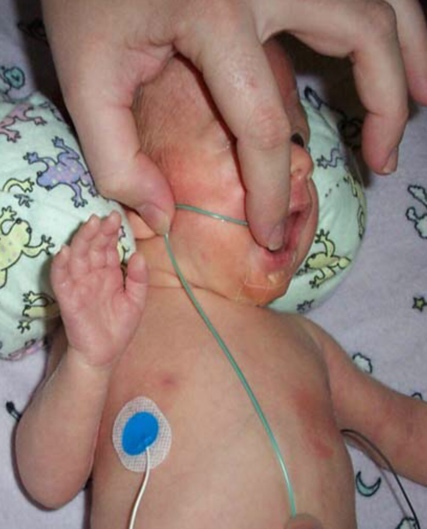 ⁨تغذیه نوزادان با لوله,نوزادان نارس | نوبت دهی دکتر حسینی - فوق تخصص کبد و گوارش