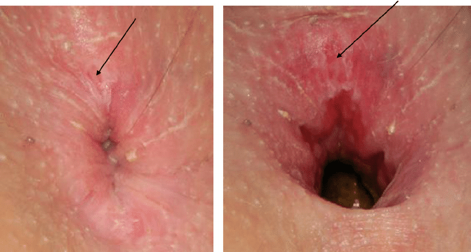 فیشرآنال یا زخم ناحیه مقعد ناشی از یبوست