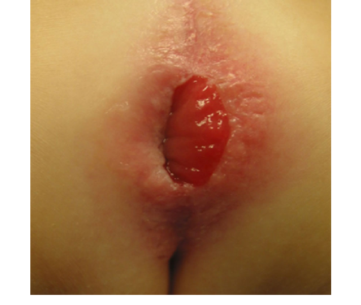 پرولاپس رکتوم یا بیرون زدگی بخشی از روده از مقعد بدنبال زورزدن ناشی از یبوست